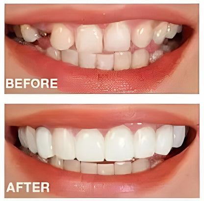 Denture Molds for Teeth (Top & Bottom) - Get Instant Veneers Smile & Confidence