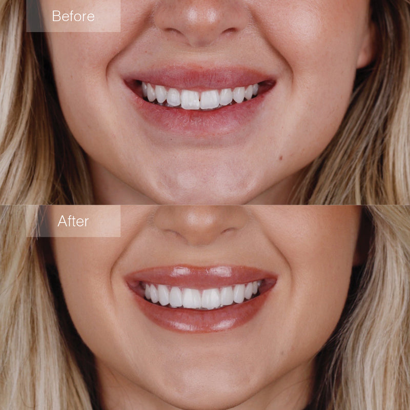 Denture Molds for Teeth (Top & Bottom) - Get Instant Veneers Smile & Confidence